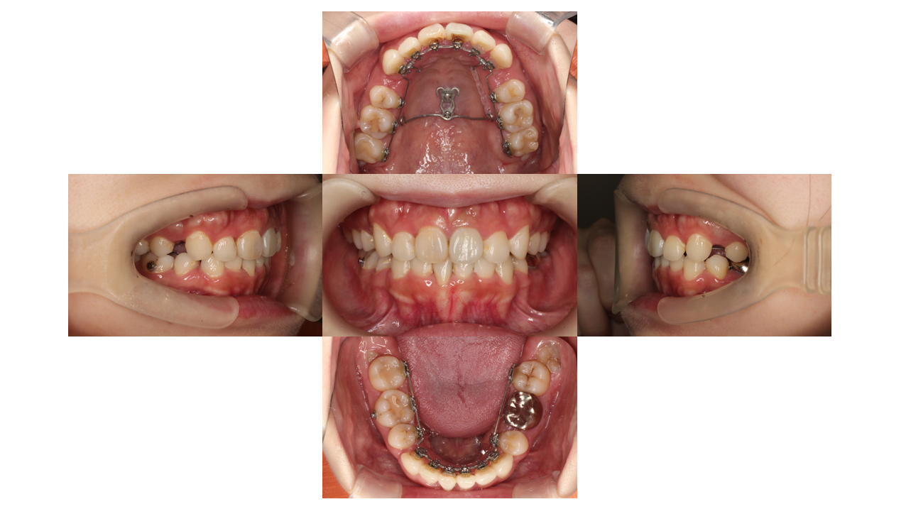 下顎叢生、リンガル 