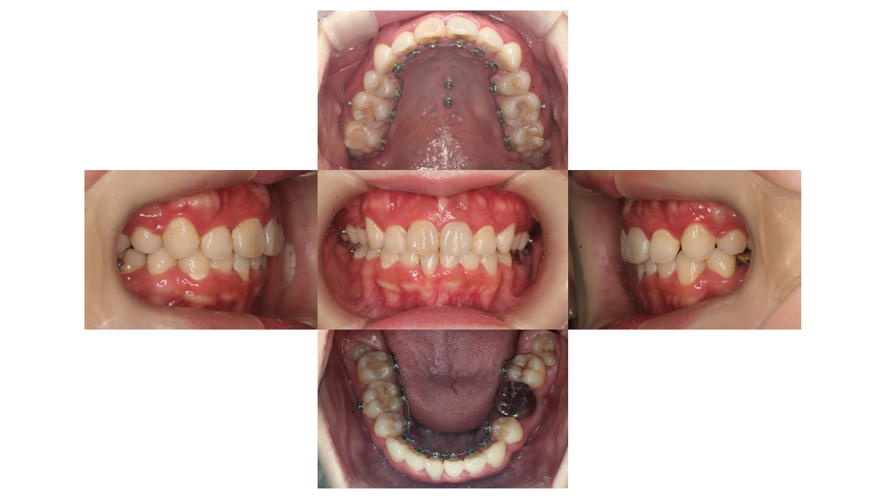 下顎叢生、リンガル