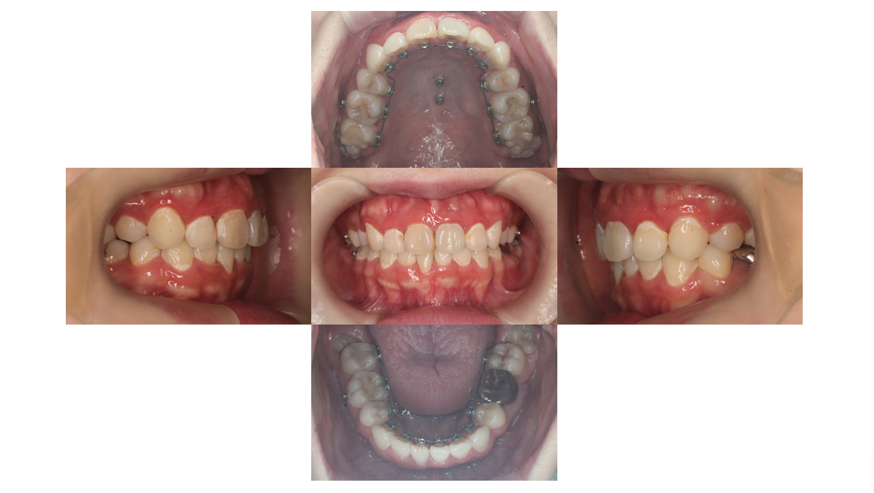下顎叢生、リンガル