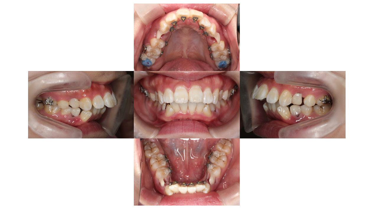 出っ歯、叢生、リンガル