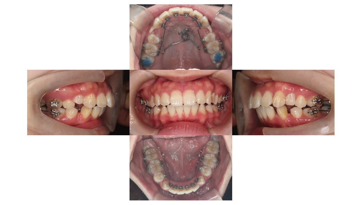 出っ歯、叢生、リンガル