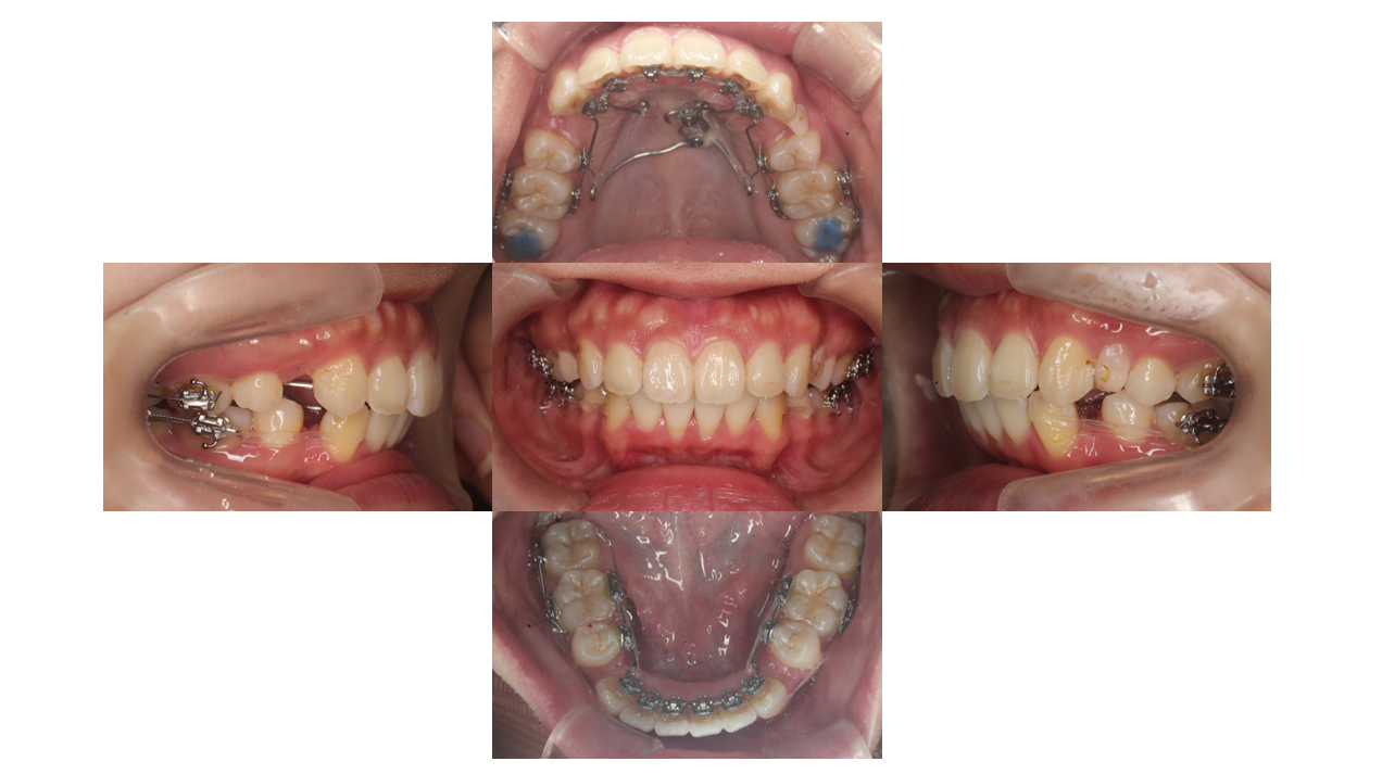 出っ歯、叢生、リンガル 