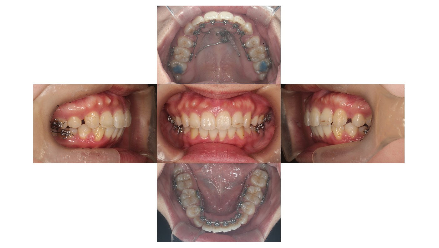 出っ歯、叢生、リンガル