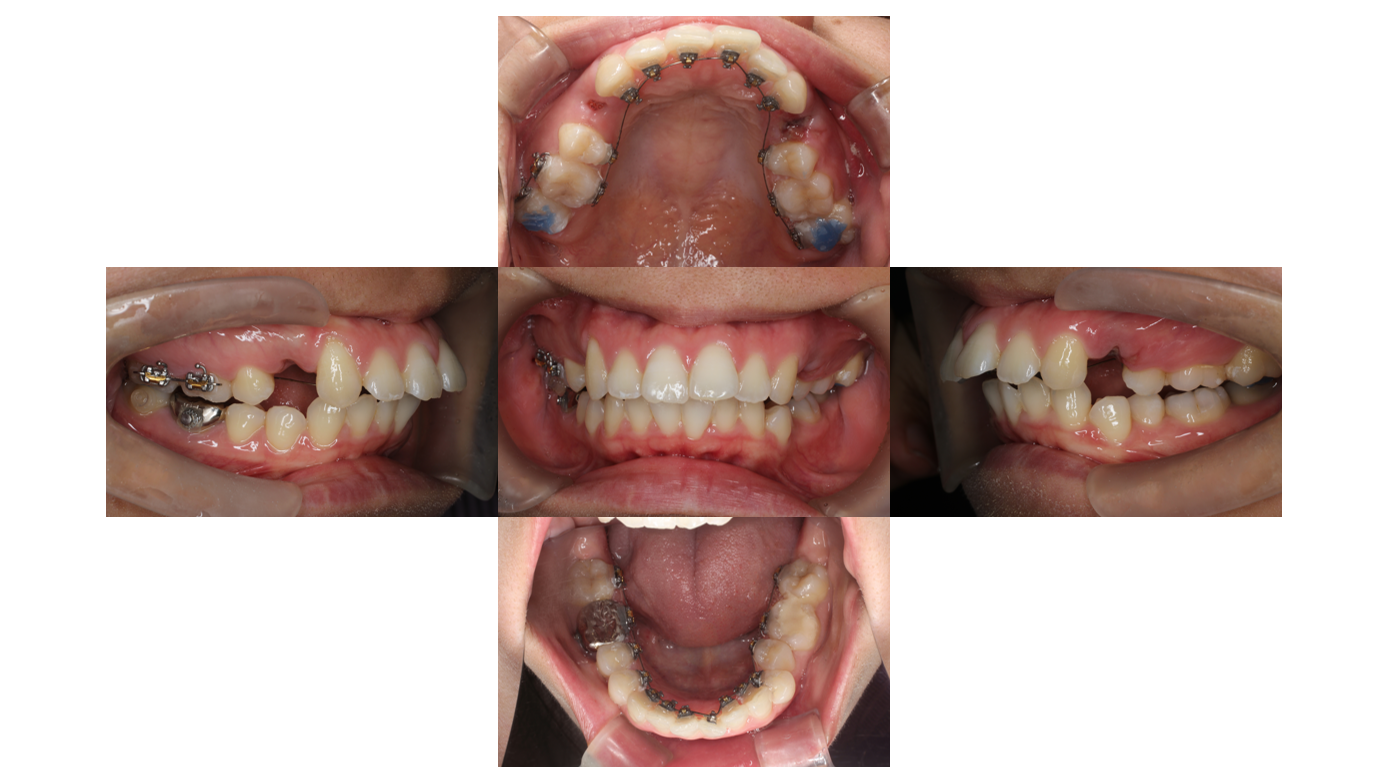 上顎前突、リンガル