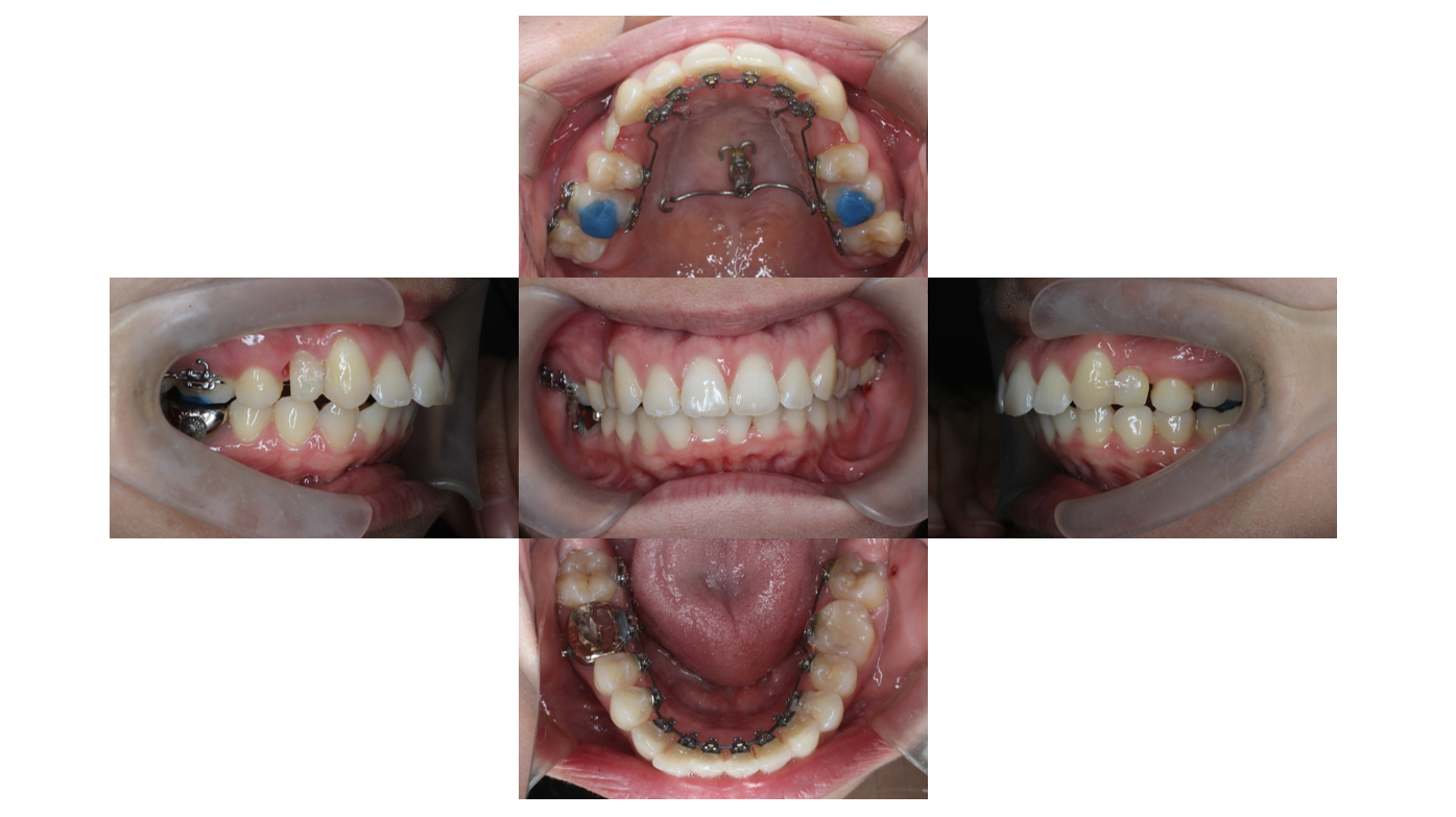 上顎前突、リンガル