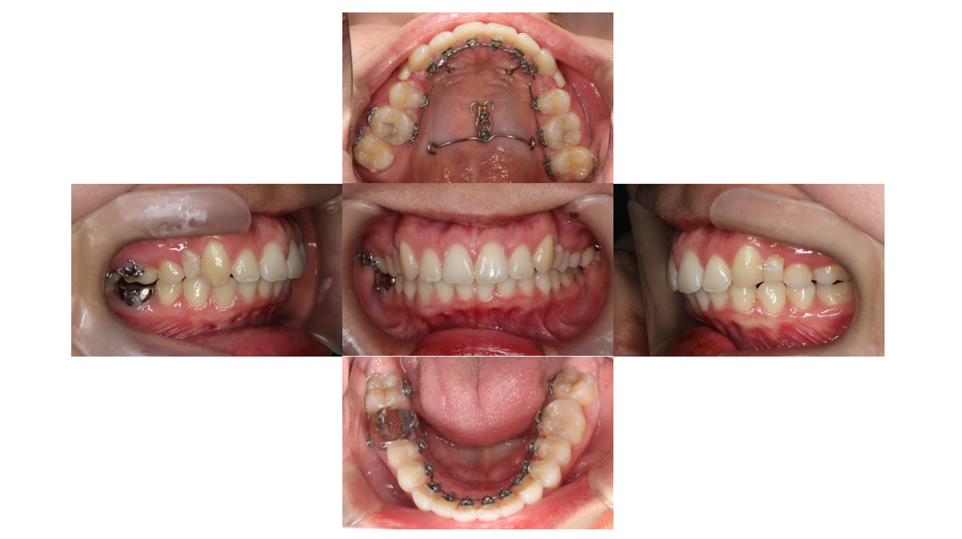 9か月、リンガル、上顎前突、