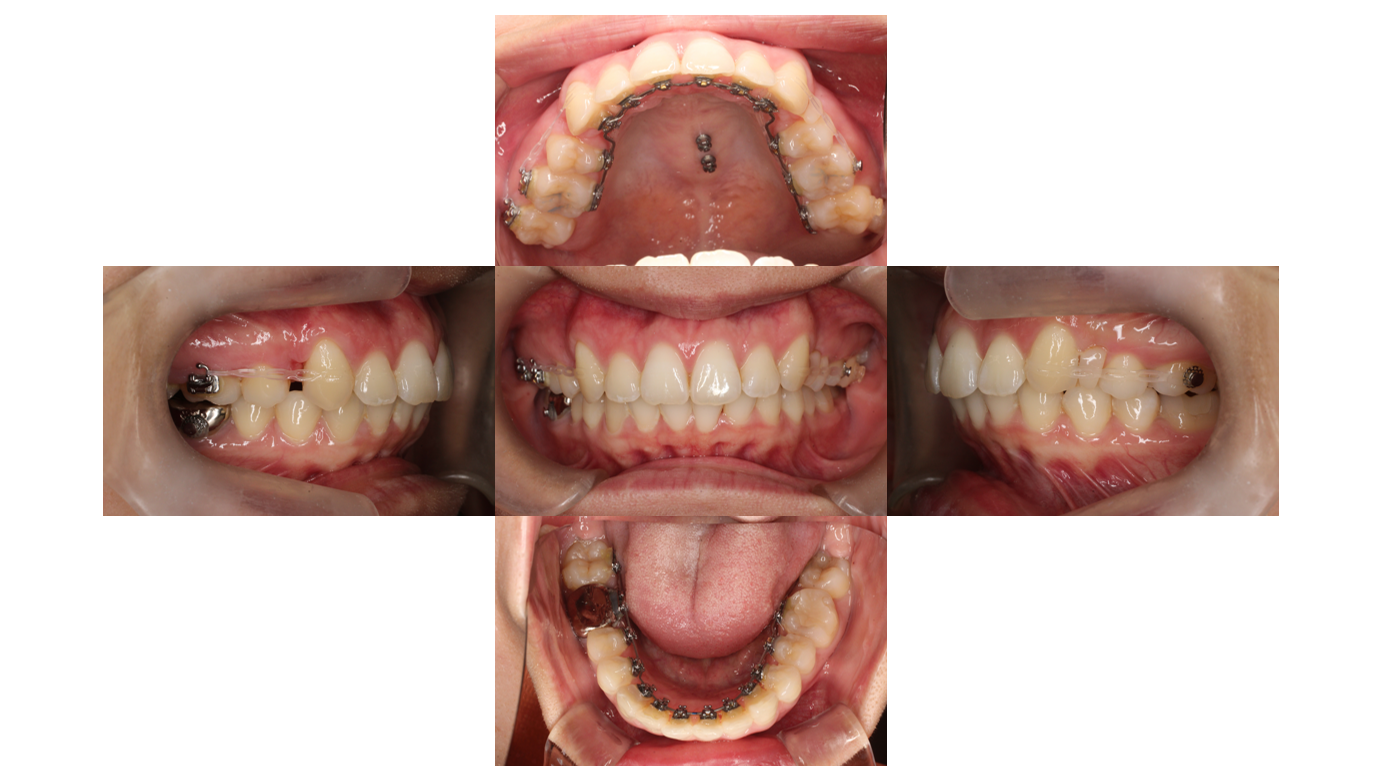 15か月、裏側矯正、出っ歯