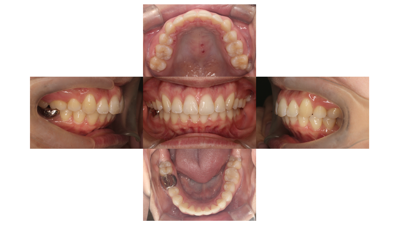 28か月、リンガル、上顎前突