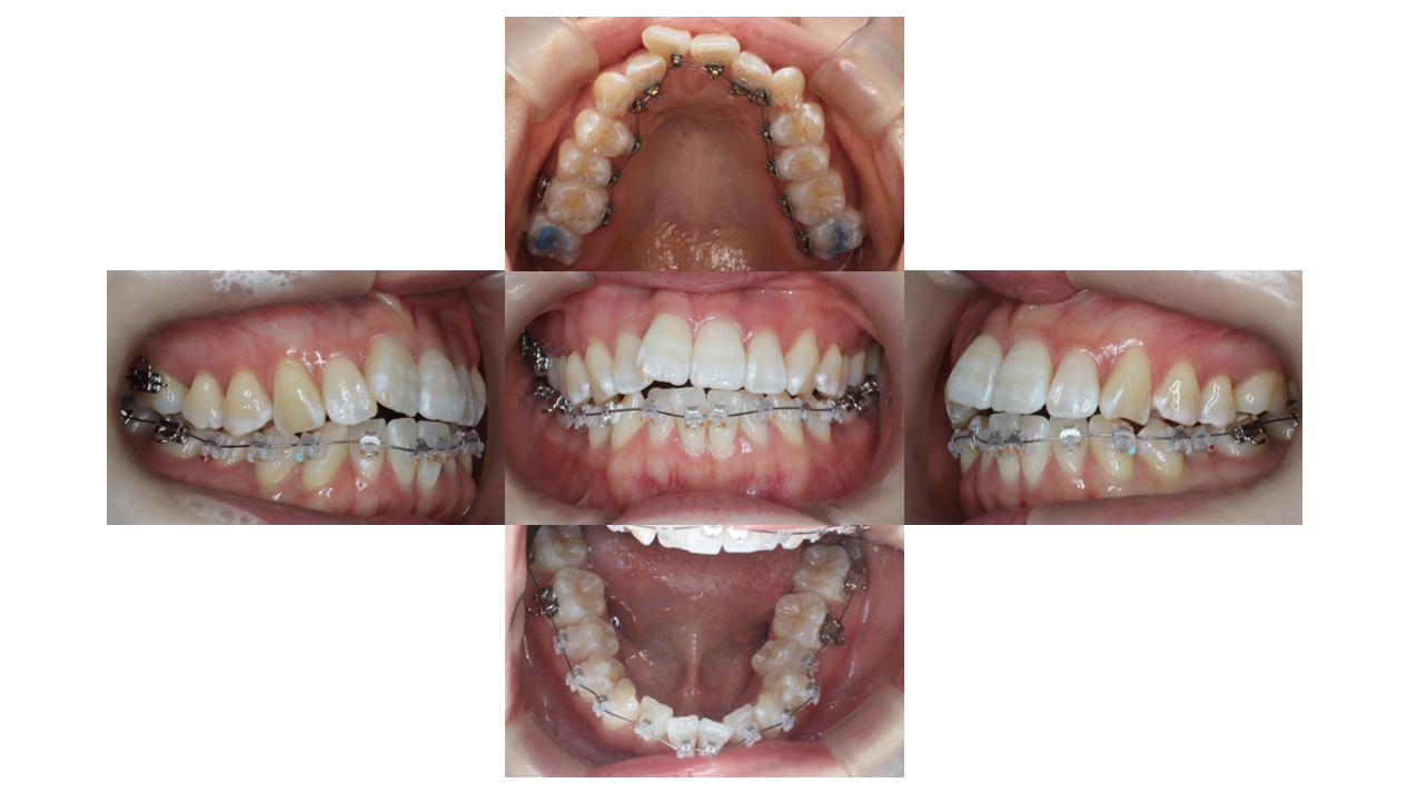 叢生、ﾊｰﾌリンガル