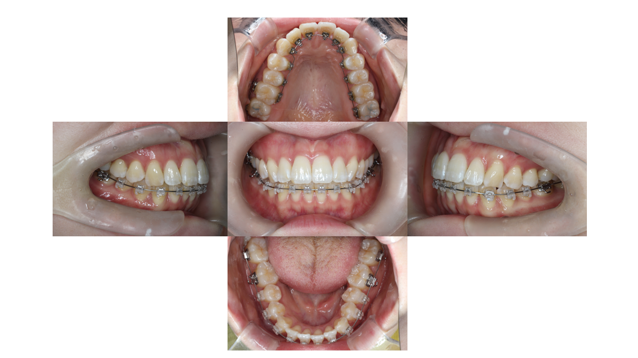 叢生、ﾊｰﾌリンガル 