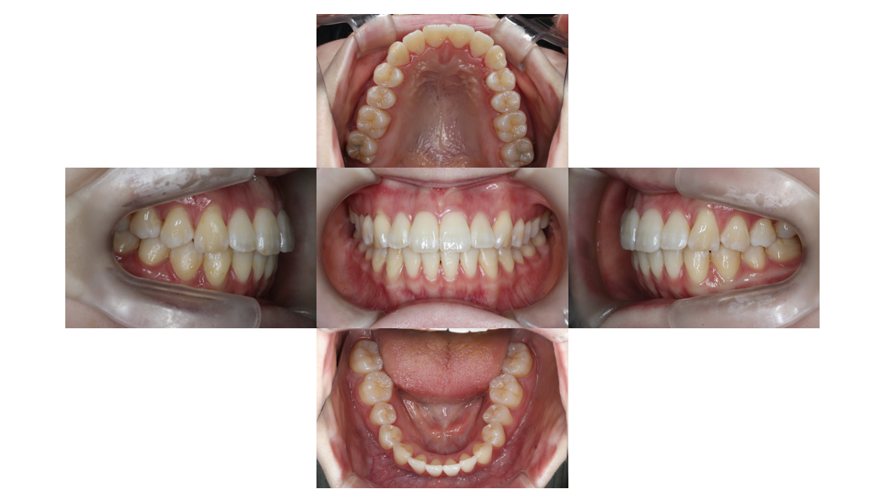 13か月、叢生、ﾊｰﾌリンガル