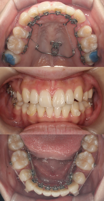 叢生、リンガル