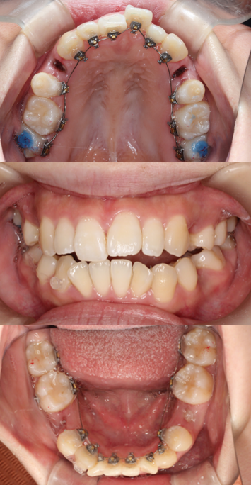 叢生、リンガル