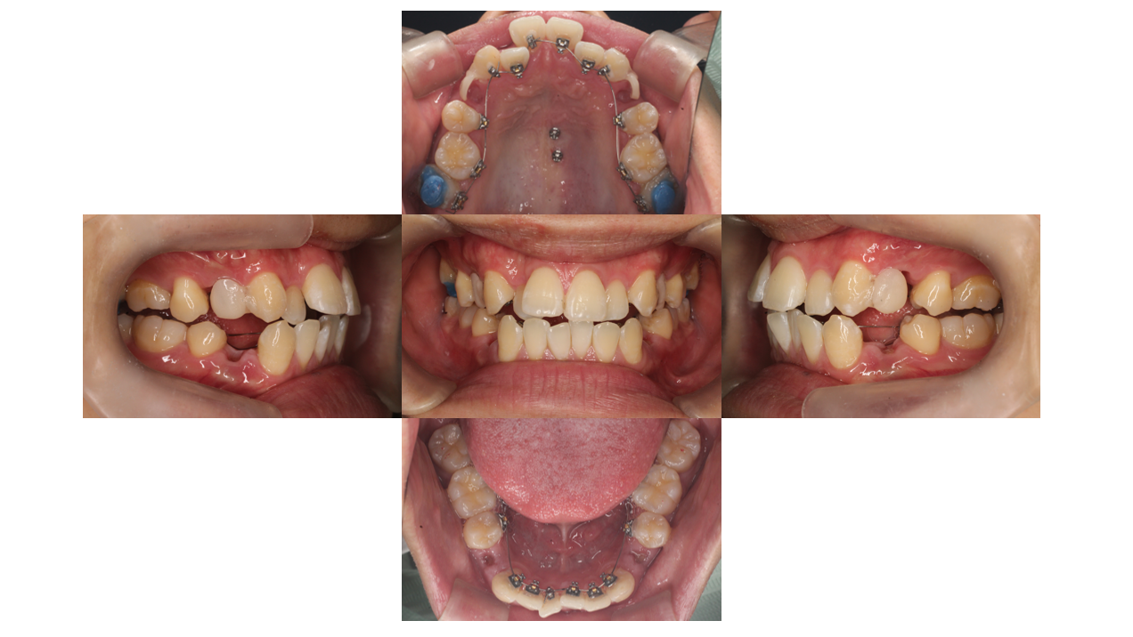 装置装着時、叢生、リンガル
