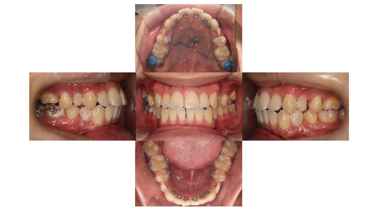 4か月、叢生、リンガル