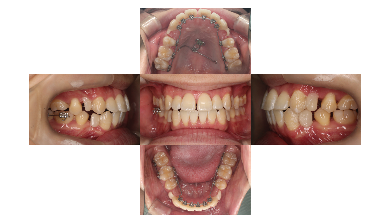 叢生、リンガル