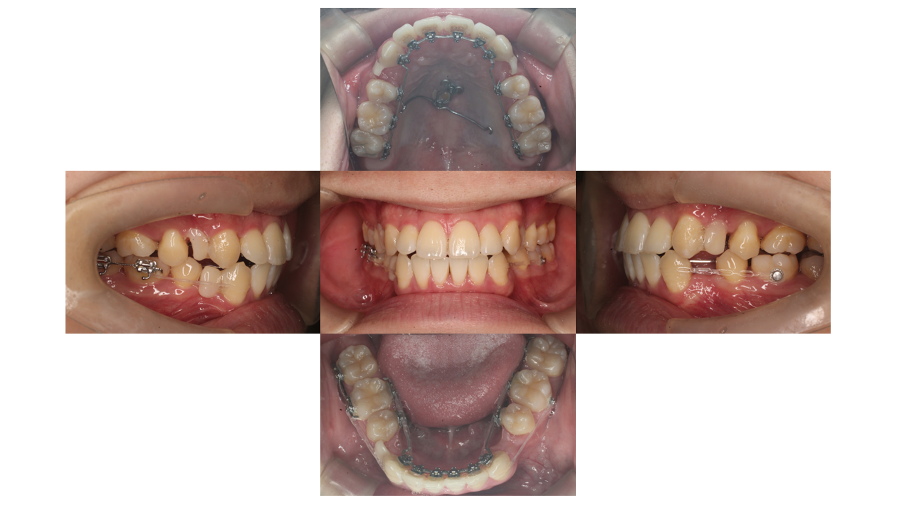 装置、リンガル