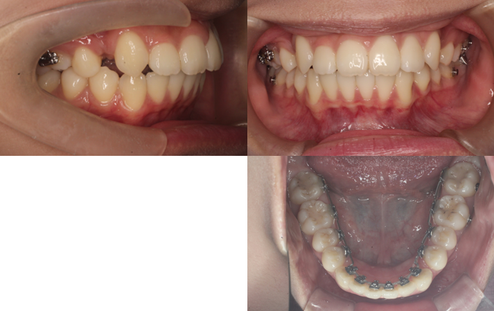 上顎前突、正中離開、リンガル