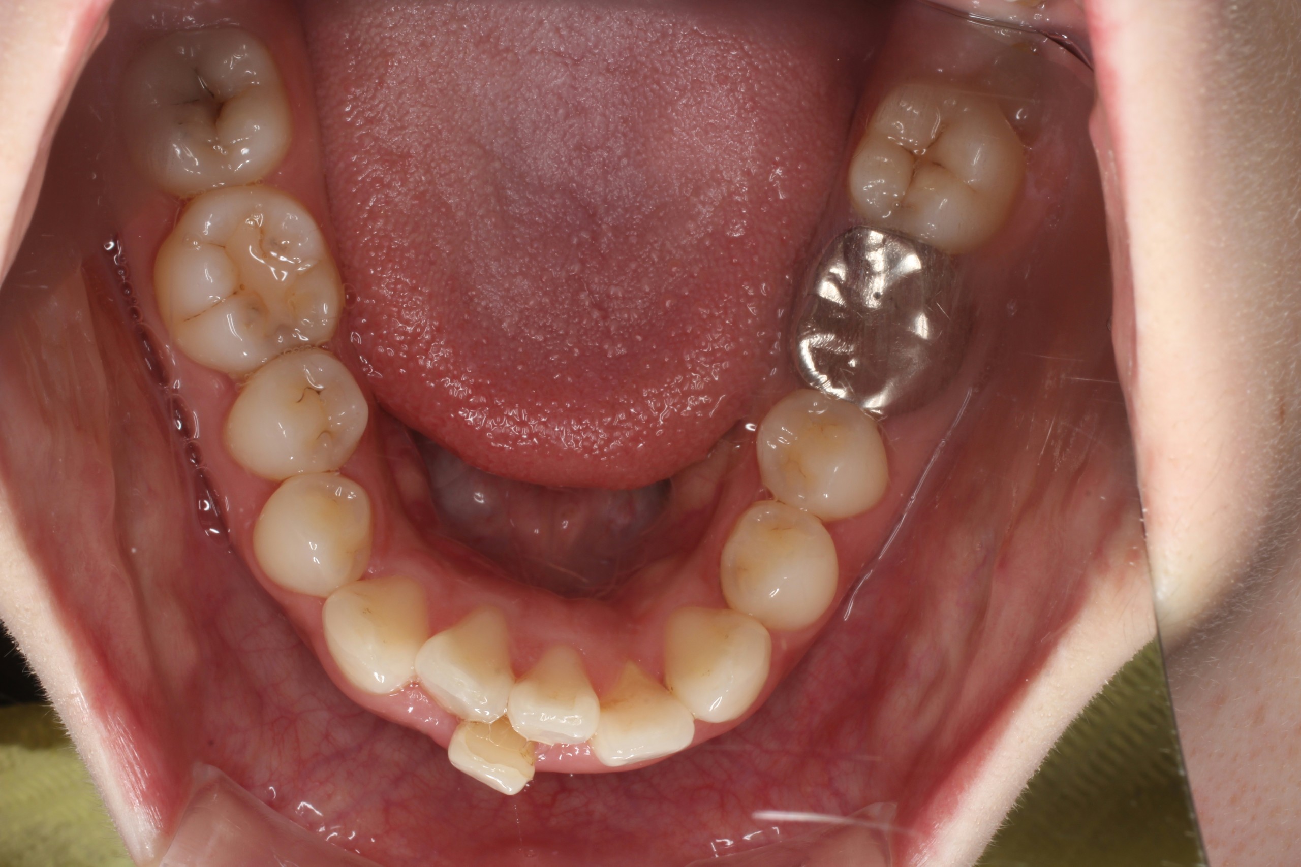 叢生、口元下げる、リンガル