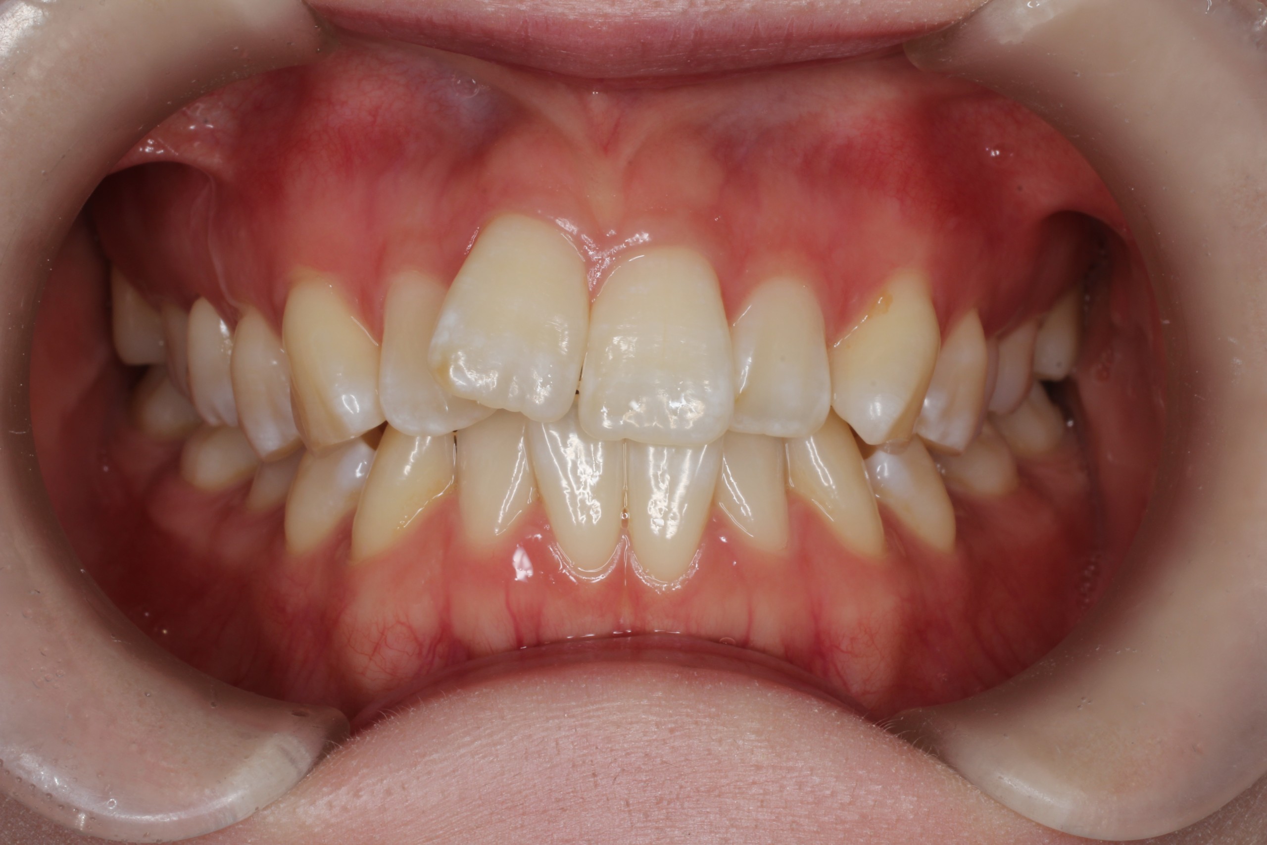 叢生、非抜歯、ﾊｰﾌリンガル