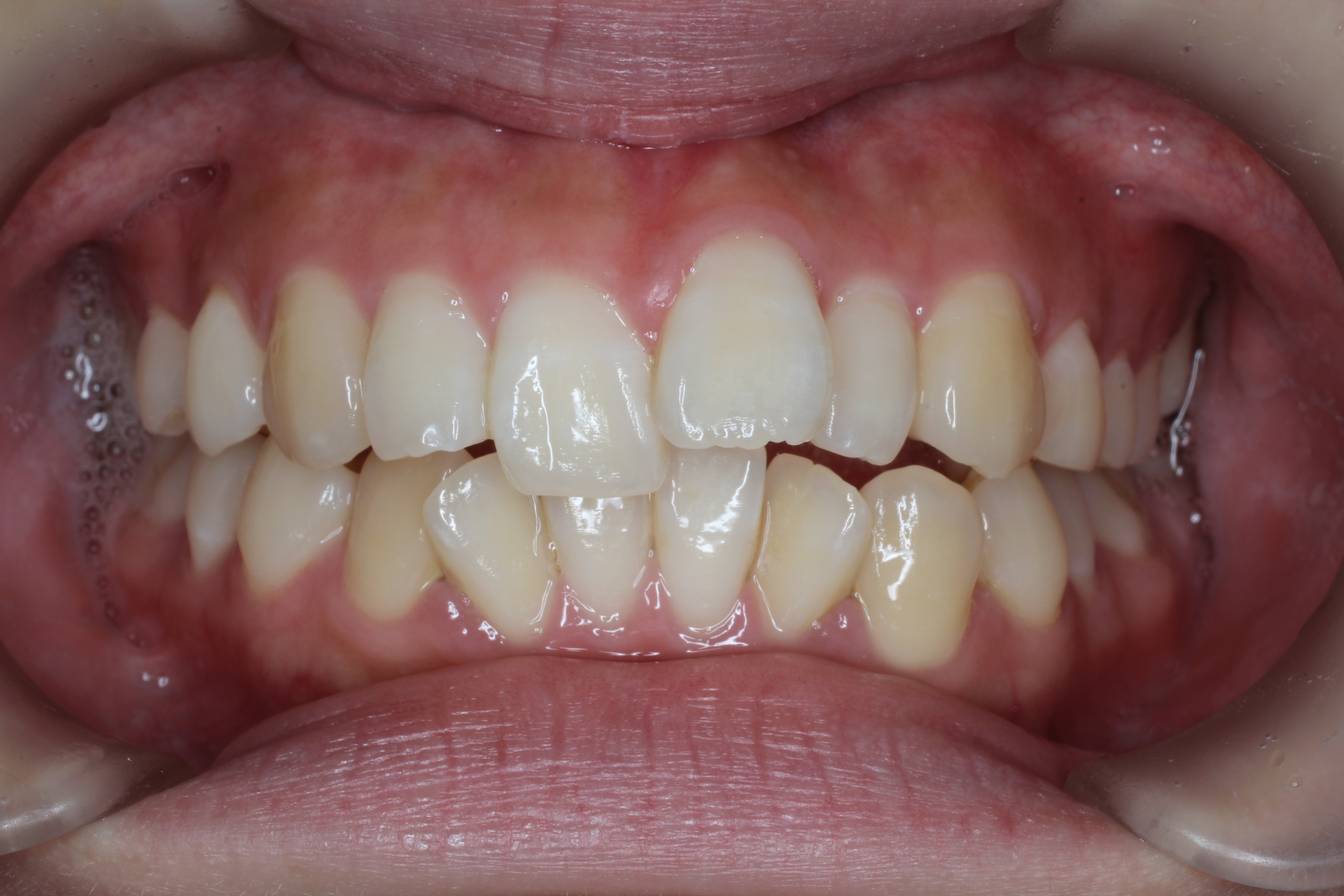 叢生、リンガル