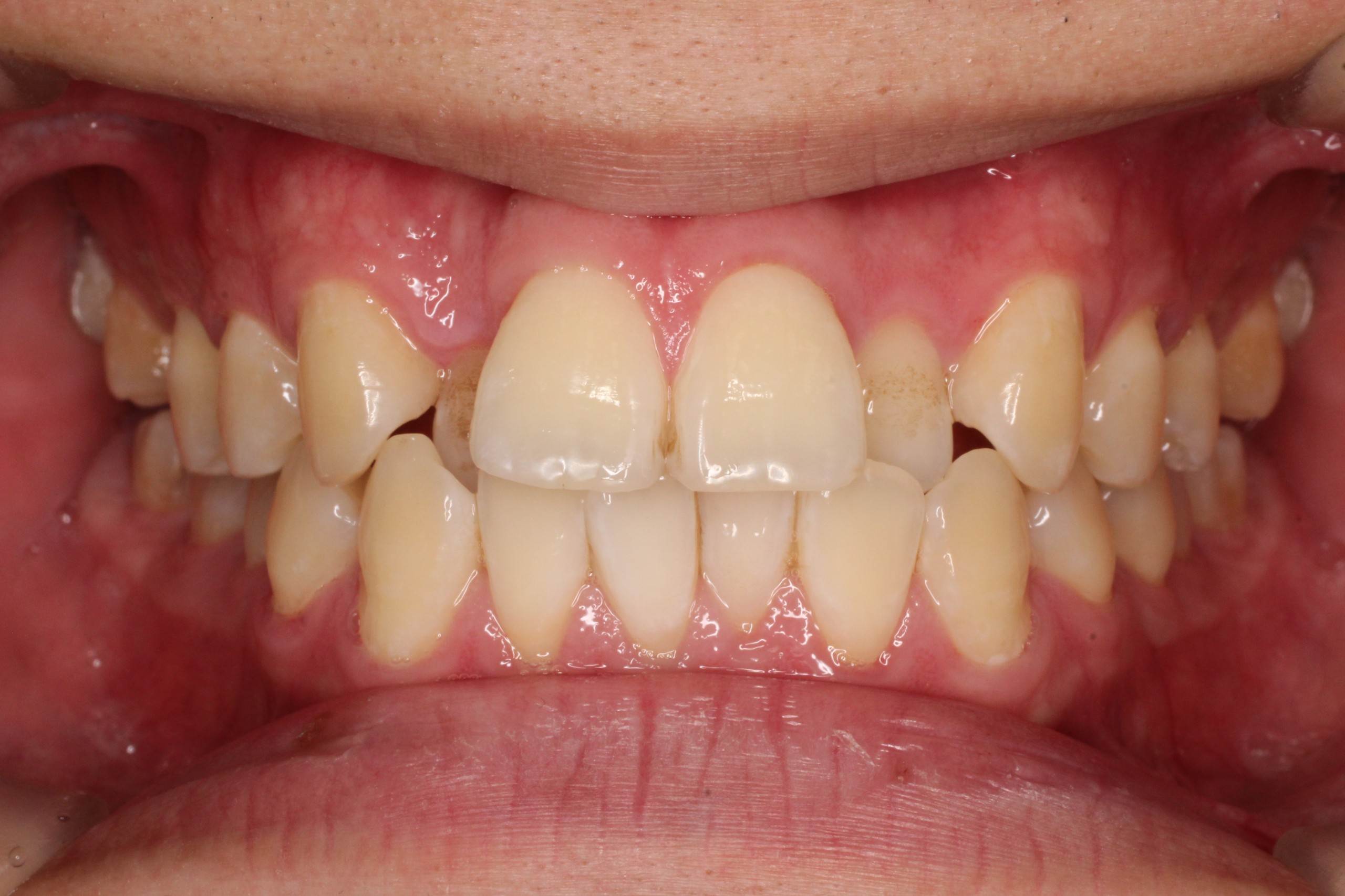 叢生、リンガル