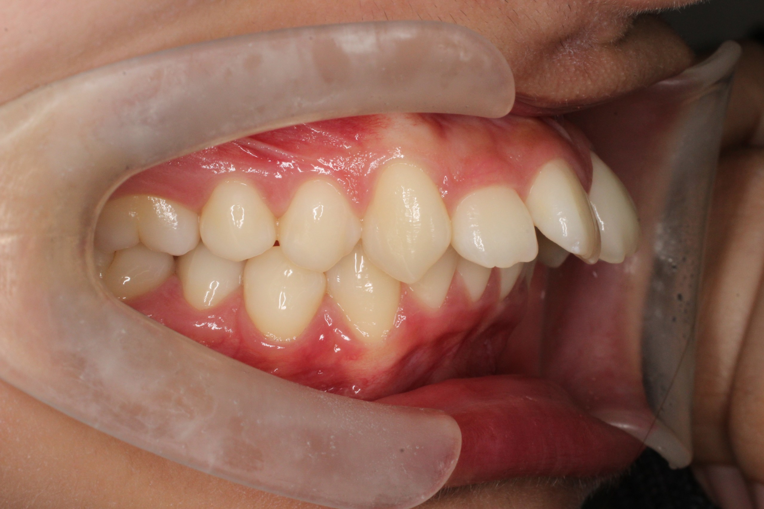 上顎前突、正中離開