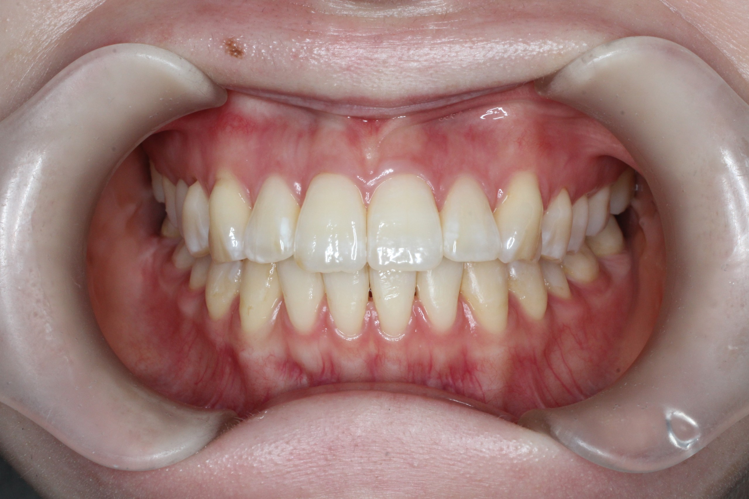 叢生、非抜歯、ハーフリンガル