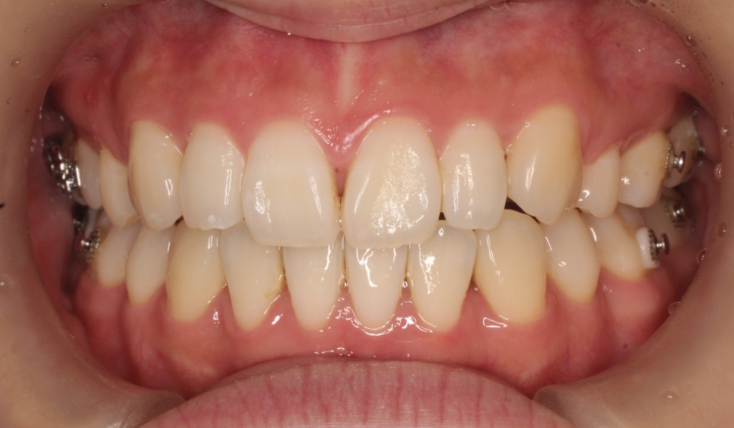 叢生、リンガル