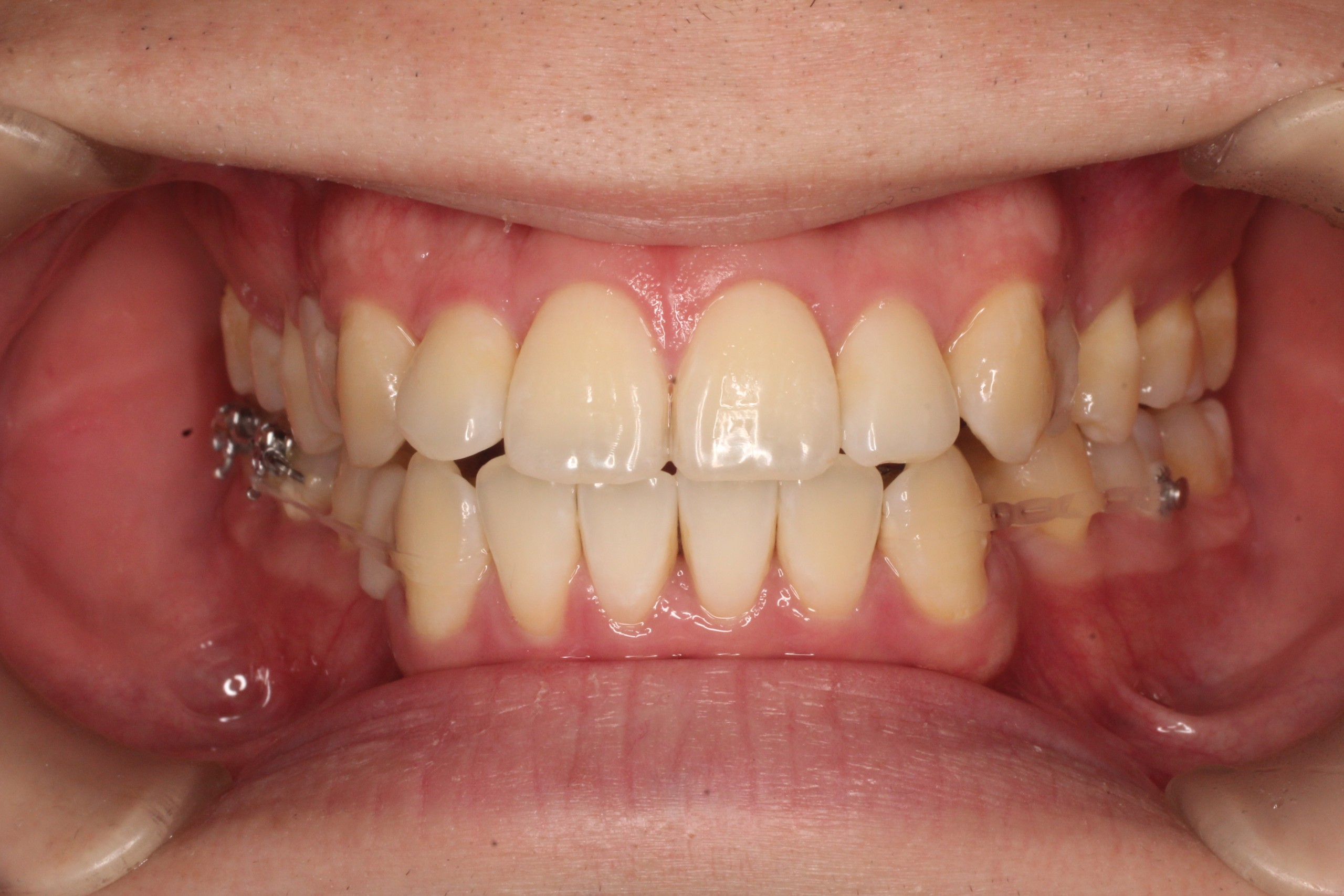 叢生、リンガル