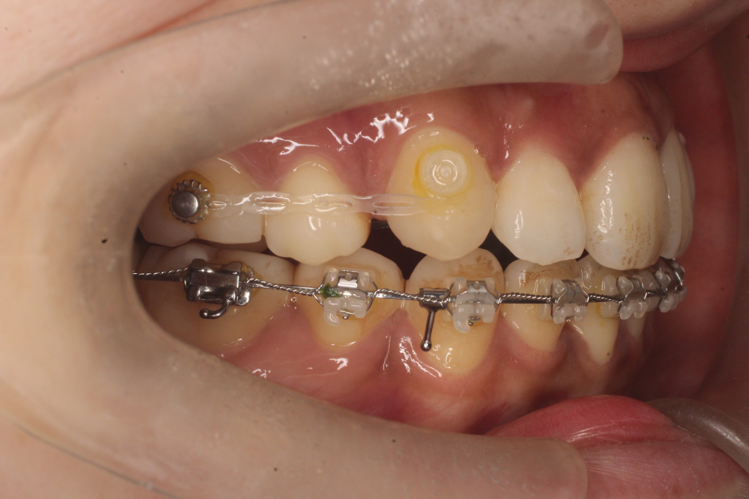 叢生開咬、ハーフリンガル