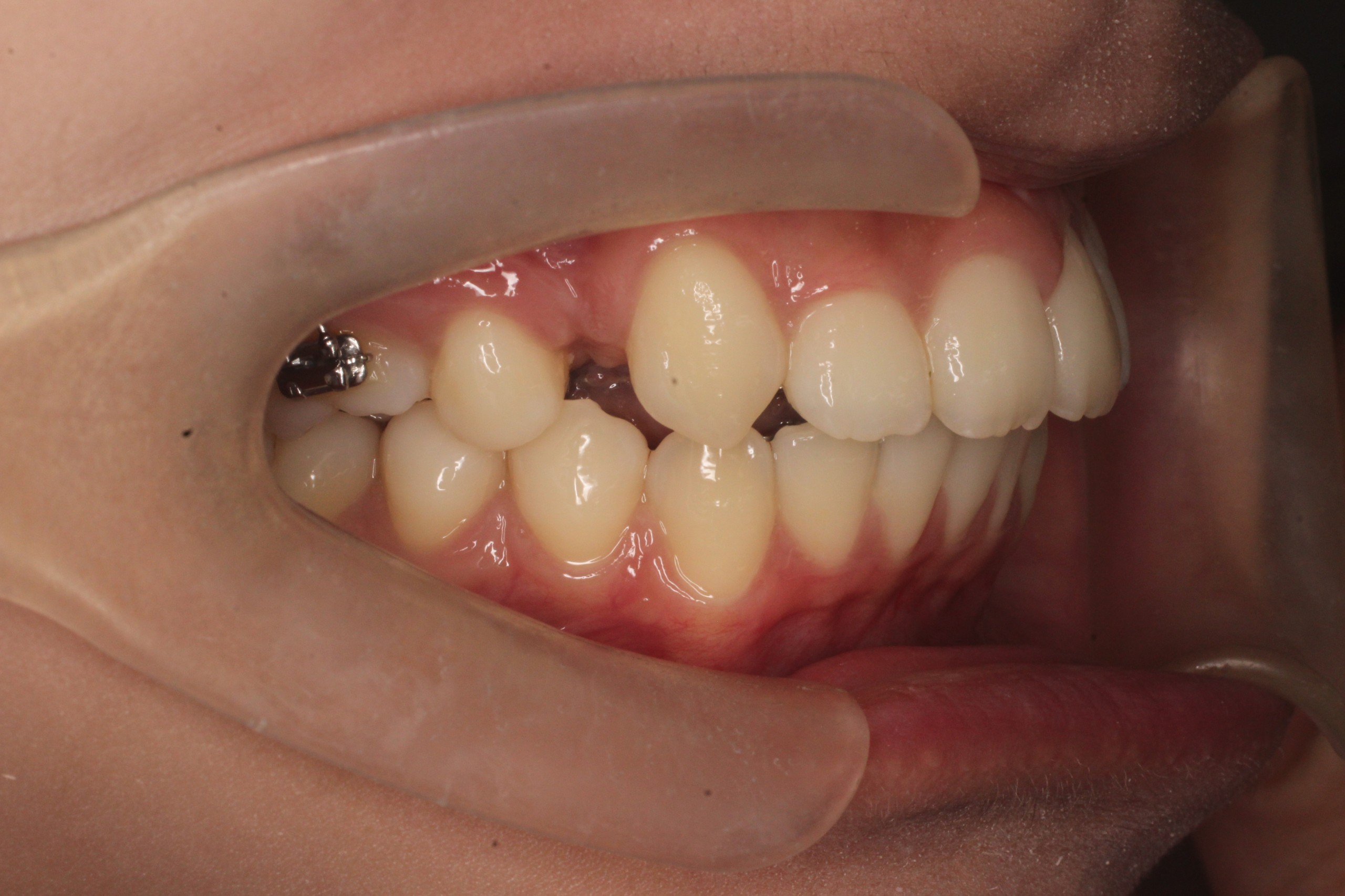 上顎前突、正中離開