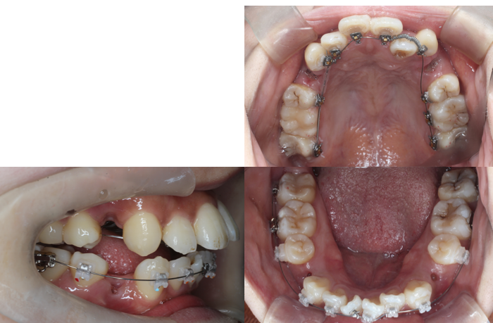 叢生、開咬、ハーフリンガル
